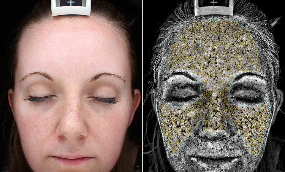 skin under uv camera